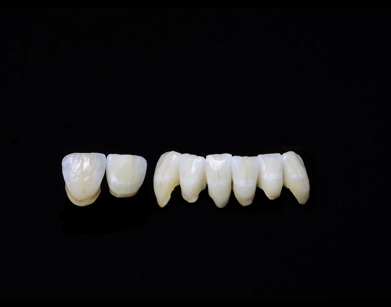 Prothèse dentaire conjointe en céramique